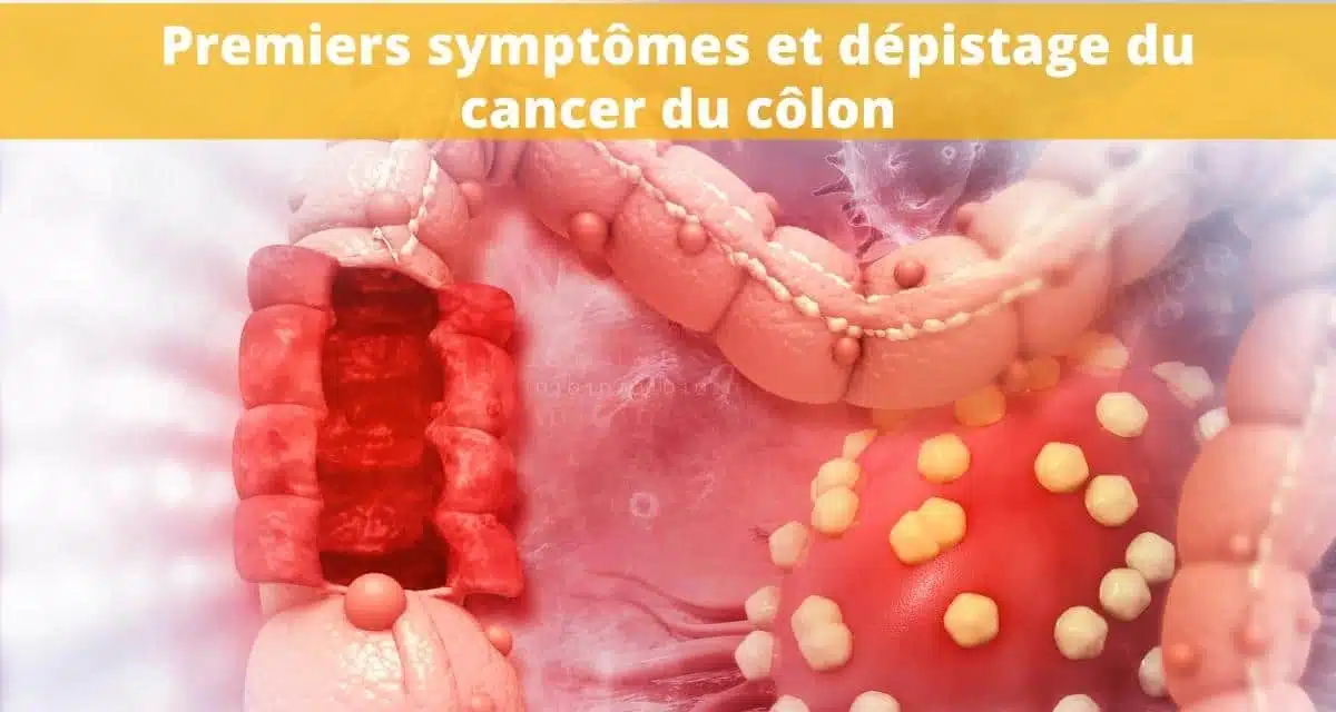 Les cancers du côlon et du rectum – Annuaire